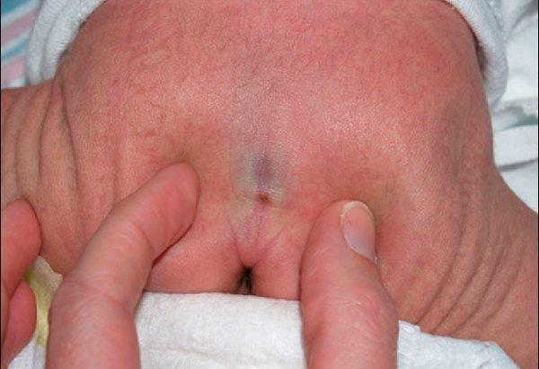 Đây là vết lõm nhỏ, nông xuất hiện khi trẻ mới sinh ra