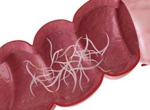 Làm cách nào để biết trẻ có bị nhiễm giun kim hay không?