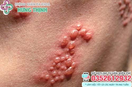 Mụn rộp sinh dục (Herpes): Dấu hiệu, hình ảnh và cách chữa