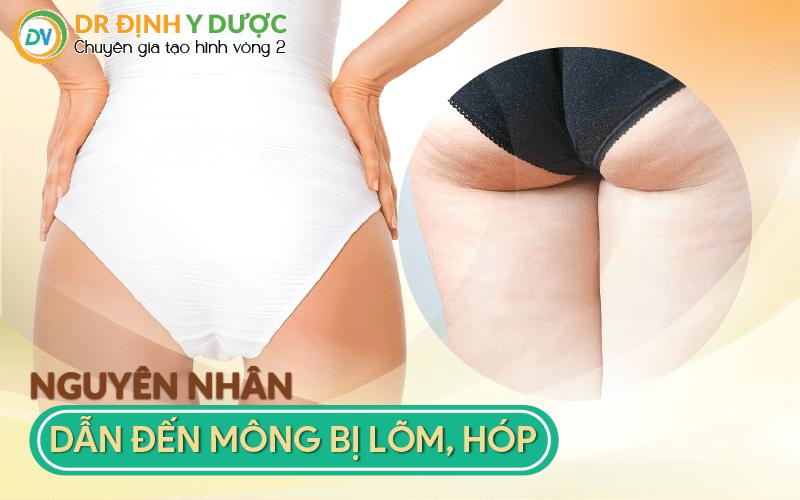 Cấy Mỡ Tự Thân Vào Mông - Cách Cải Thiện Vòng 3 Sexy