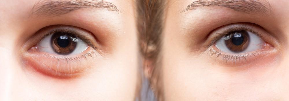 SƯNG MẮT - NGUYÊN NHÂN VÀ CÁCH PHÒNG TRÁNH