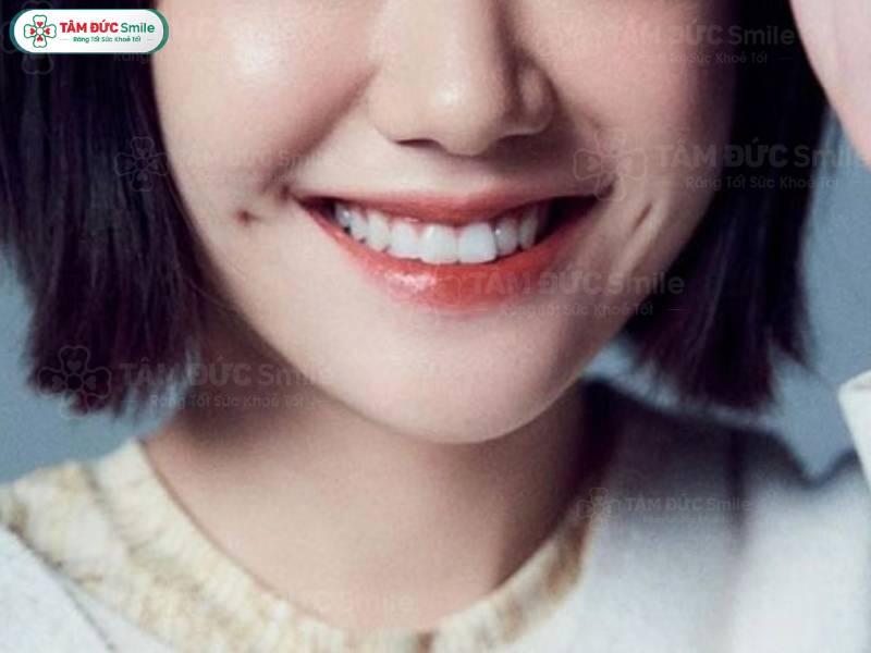 Đồng điếu ở rãnh cười tốt hay xấu? Có ý nghĩa gì?