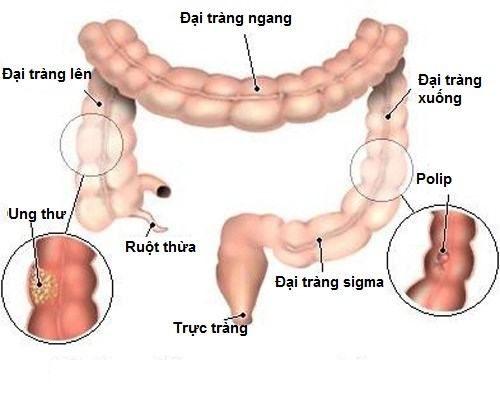 ️ Polyp đại tràng ngang là gì?