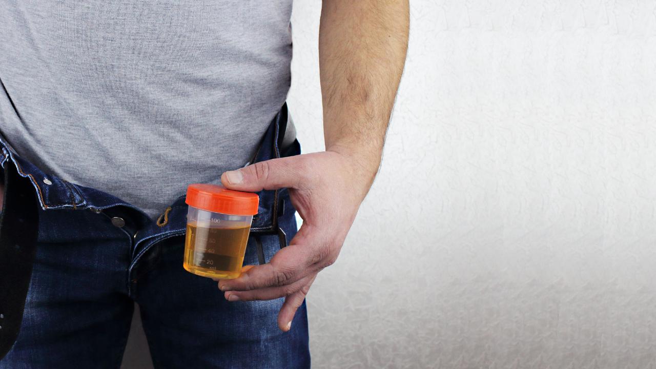 Vì sao nước tiểu màu vàng đậm?