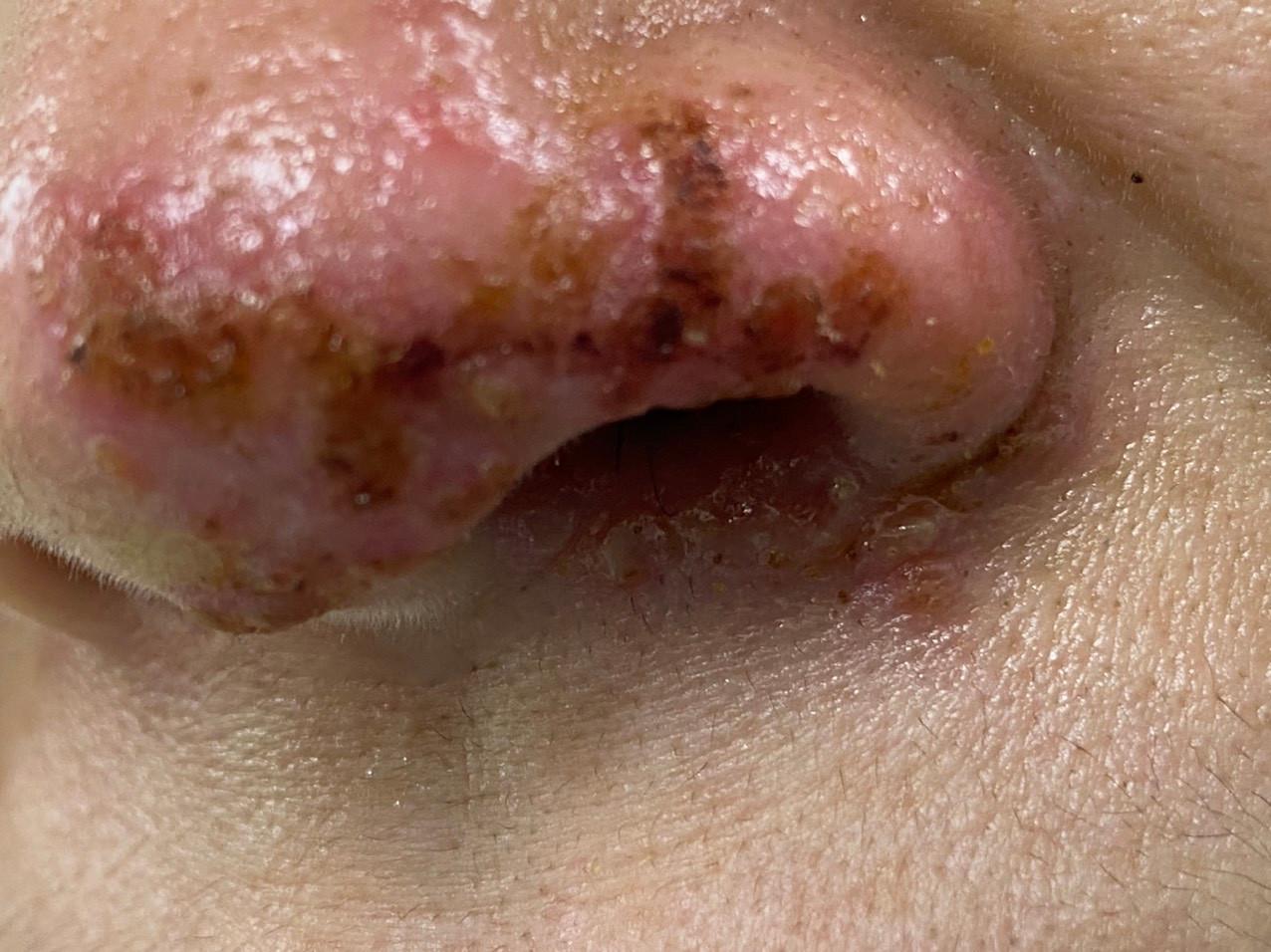 Làm đẹp cấp tốc dịp Tết: Cảnh báo những tai biến khôn lường