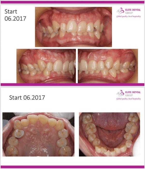 Răng mọc chen chúc nên niềng răng như thế nào?