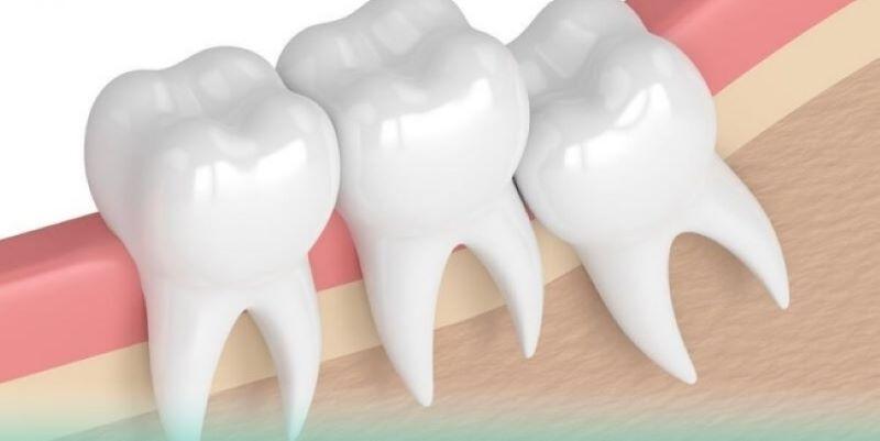 Bộ ảnh chế răng khôn hài hước