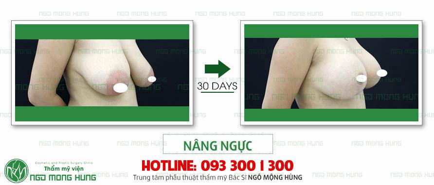 Ảnh ngực chảy xệ