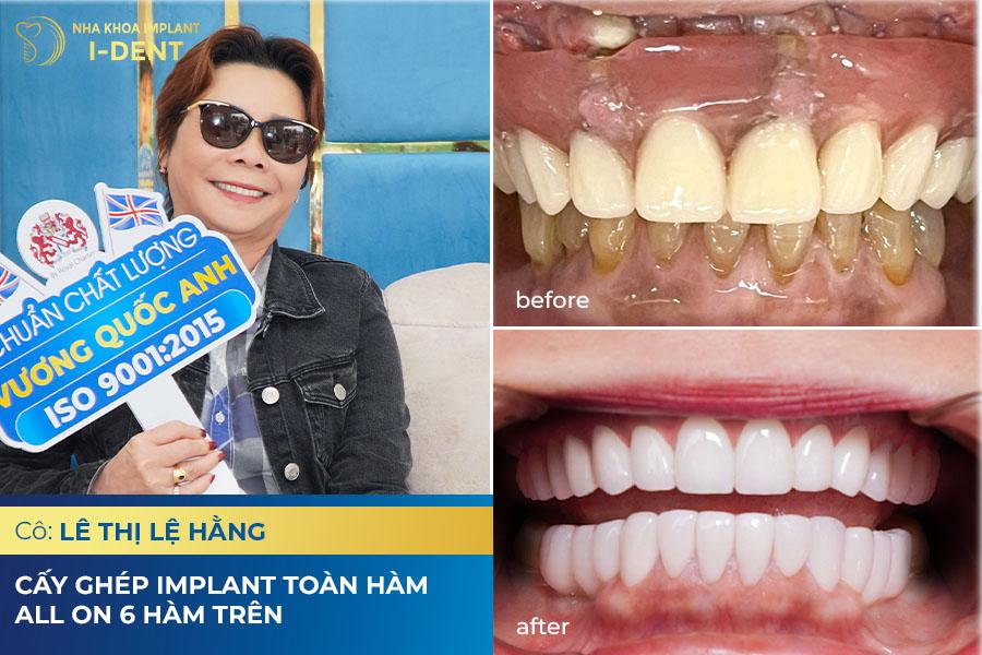 Trồng răng phục hình là gì? Những điều cần lưu ý
